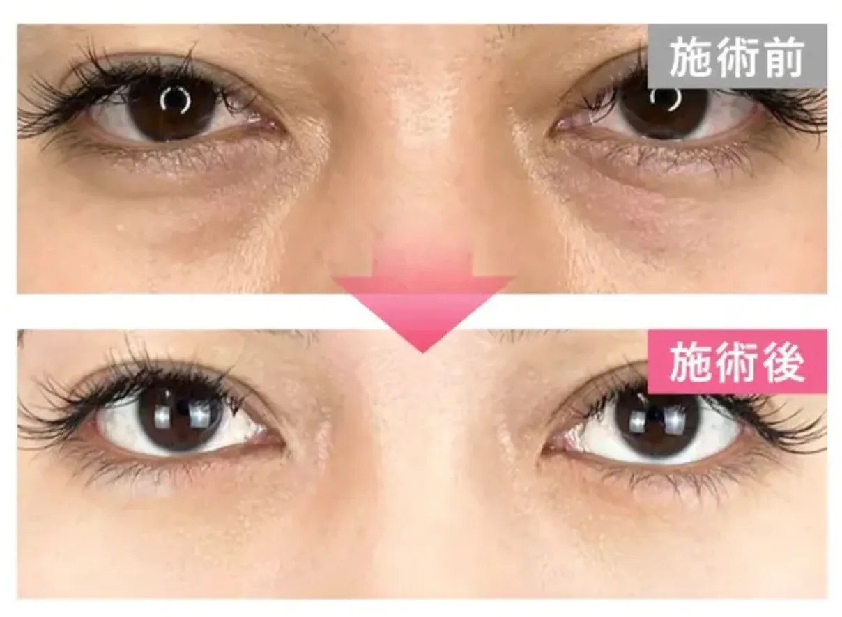 TCBのクマ取りの症例写真