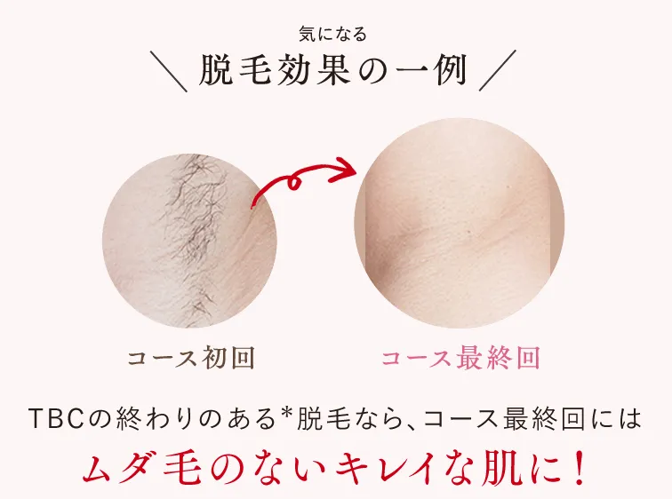 神戸でTBCの脱毛の症例