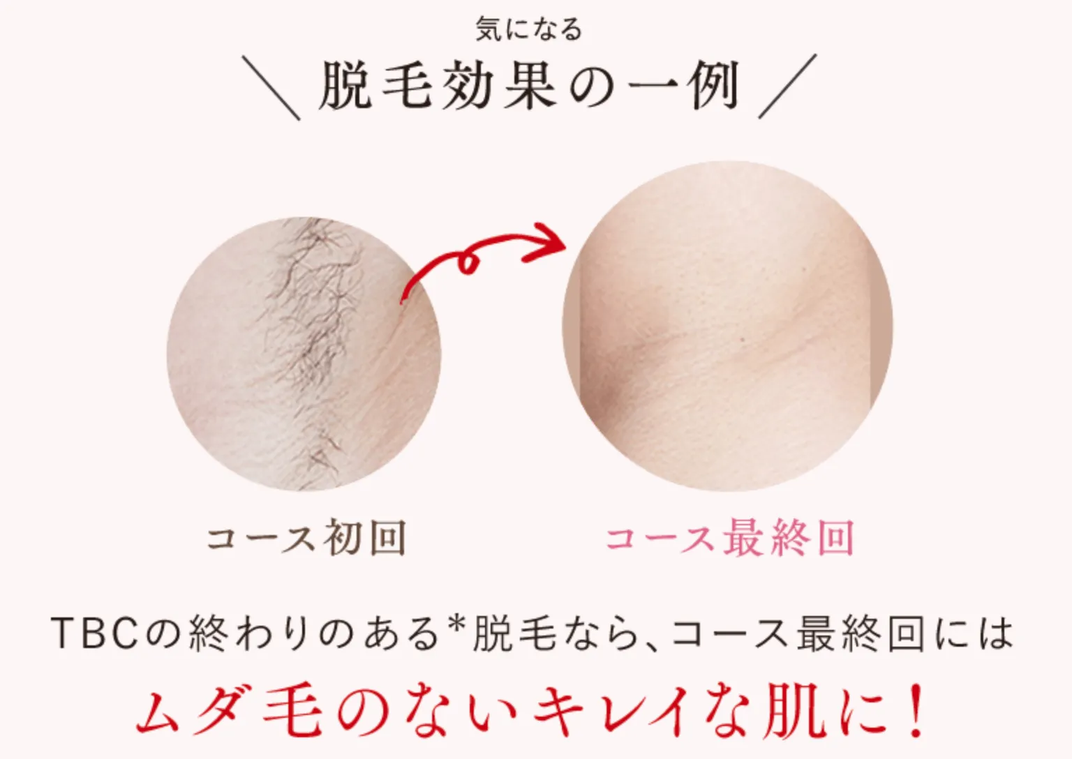 京都のおすすめ脱毛サロン　症例写真①