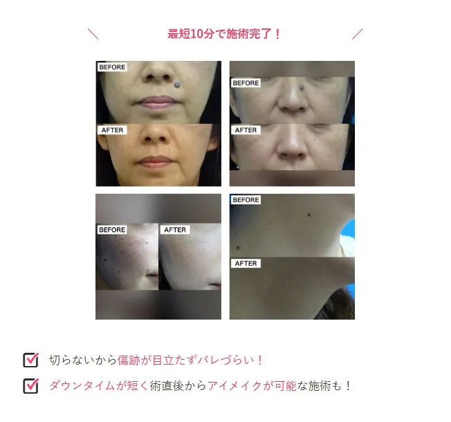 沖縄でほくろ除去がおすすめクリニック TCBのLP画像