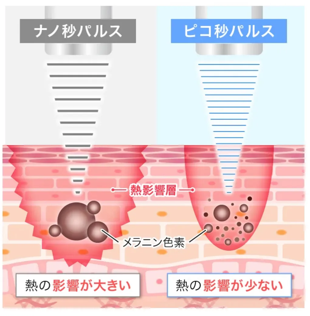 TCBのピコレーザー治療の縮図