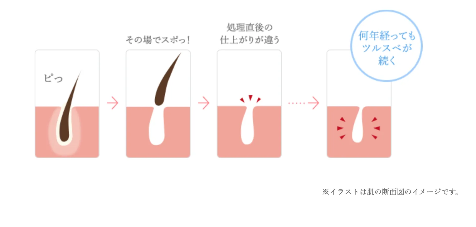 TBCの終わりのある脱毛について