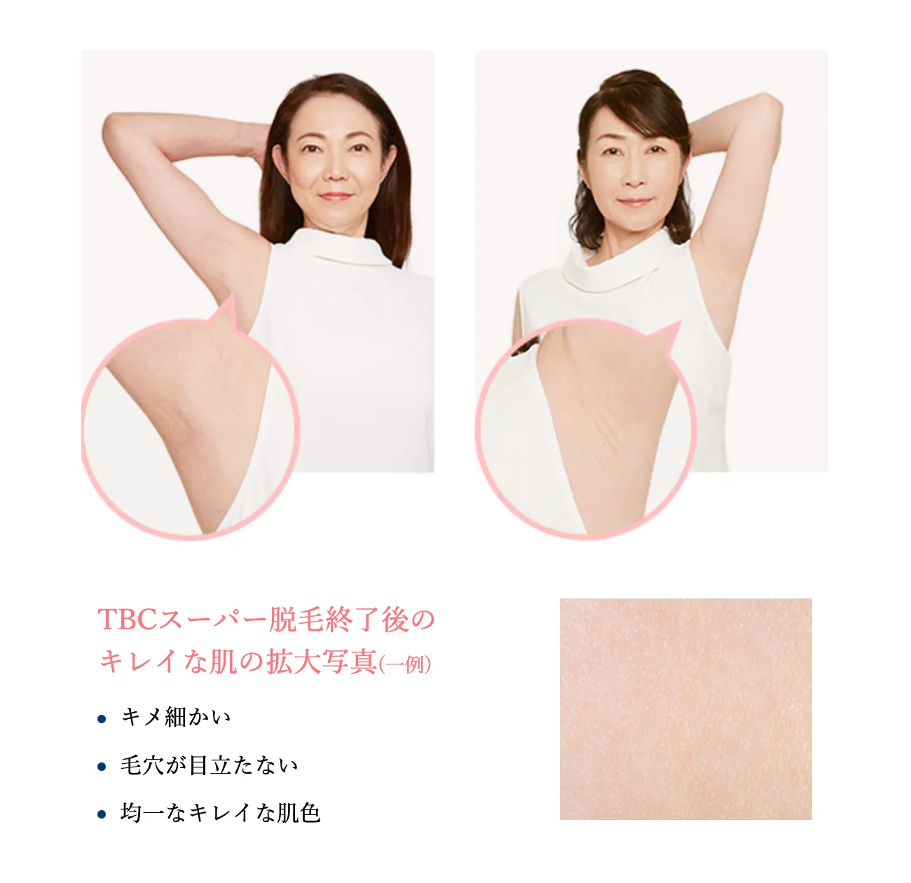 TBCのTBCスーパー脱毛終了後の写真