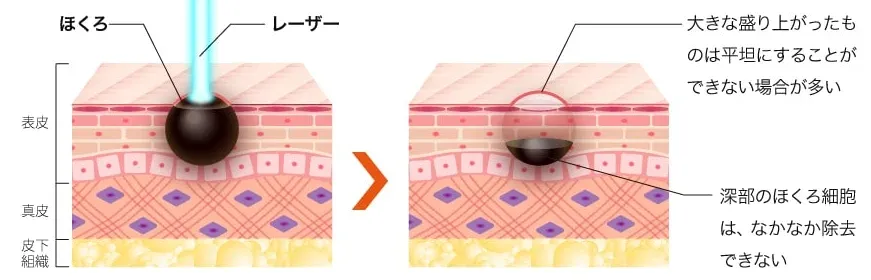沖縄でほくろ除去がおすすめクリニック TCBのLP画像