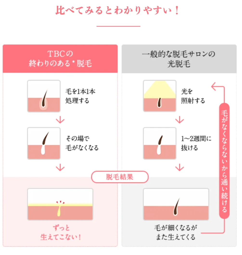 横浜でおすすめの脱毛サロンの背術方法
