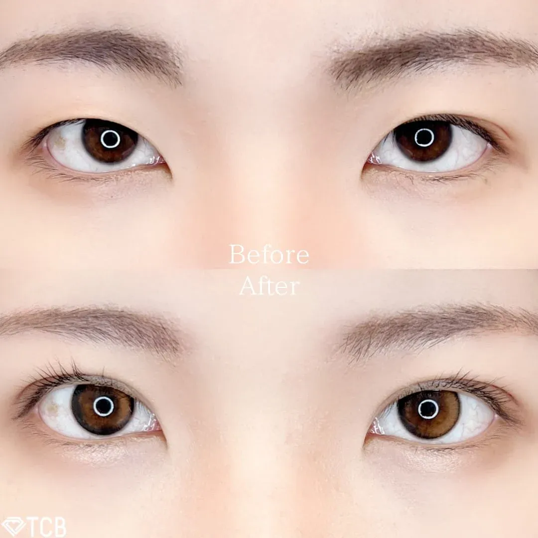 TCB小倉院の二重整形BeforeAfter