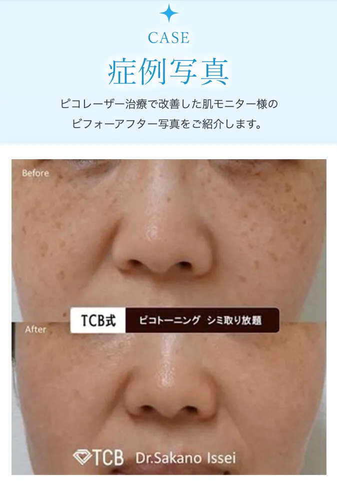 TCBのピコレーザー施術の症例写真