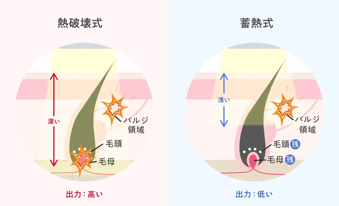 エミナルクリニック 蓄熱式と熱破壊式 説明