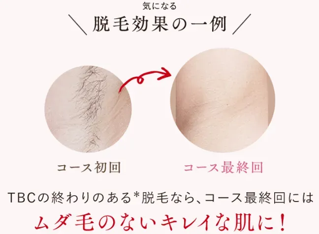 TBC 気になる脱毛効果の一例