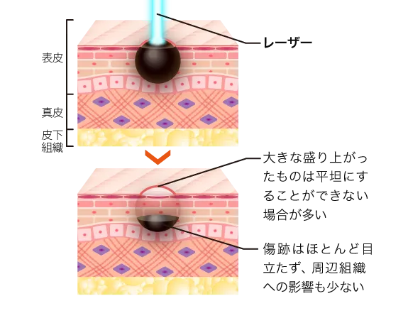 ほくろ除去のレーザー治療