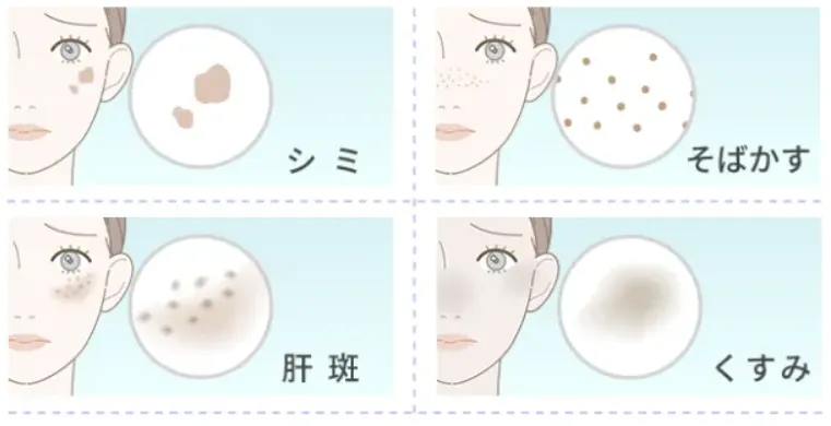 ピコレーザーがおすすめな方の紹介