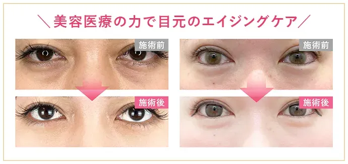 TCB クマ取り注射 Before After