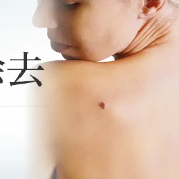 東京美容外科のほくろ除去のイメージ