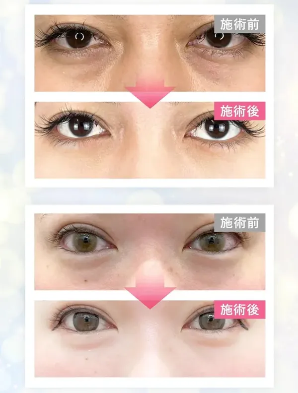 目黒区でクマ取りがおすすめのクリニック 症例写真