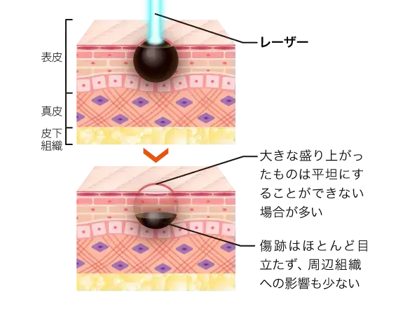 TCBほくろレーザー除去法