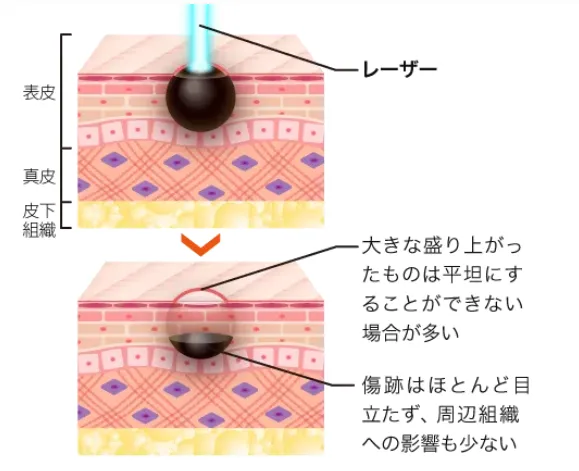 新潟でほくろ除去がおすすめのクリニック専門家が調査|ほくろ除去法レーザー治療