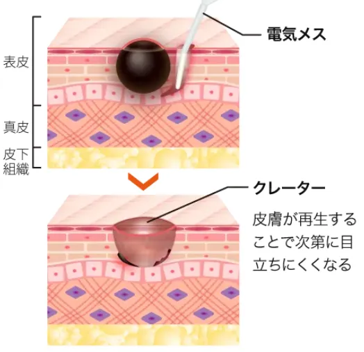 新潟でほくろ除去がおすすめのクリニック専門家が調査|ほくろ除去法電気メス