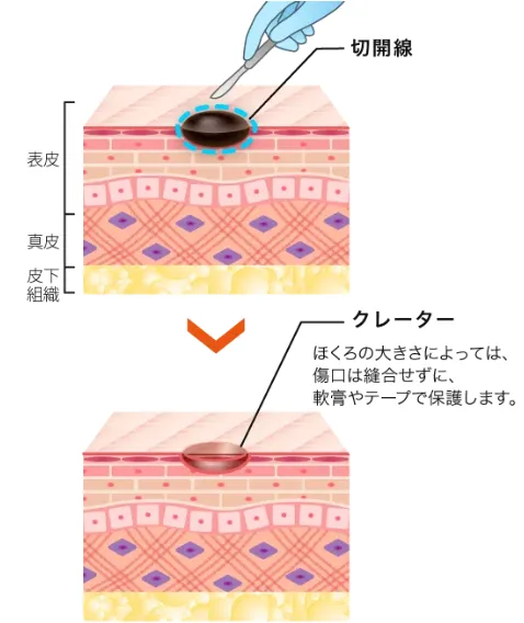 新潟でほくろ除去がおすすめのクリニック専門家が調査|ほくろ除去法くり抜き法