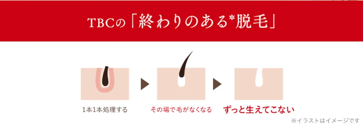 沖縄で脱毛サロンがおすすめのクリニック【専門家が徹底調査!】|TBCの終わりのある脱毛のイメージ