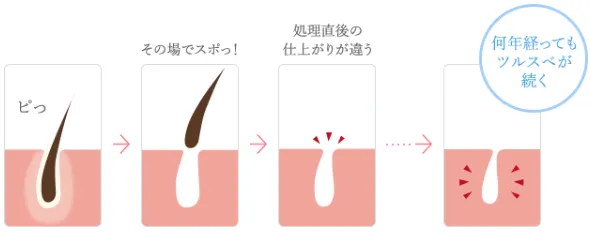 大阪のおすすめ脱毛サロン スーパー脱毛