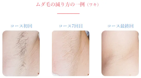 大阪のおすすめ脱毛サロン 症例写真①