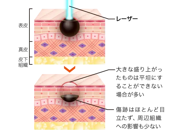TCBのレーザーによるほくろ除去