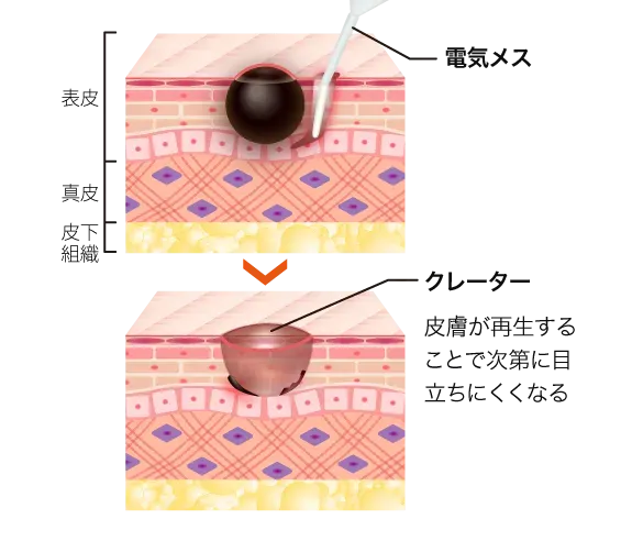 TCBの電気メスによるほくろ除去