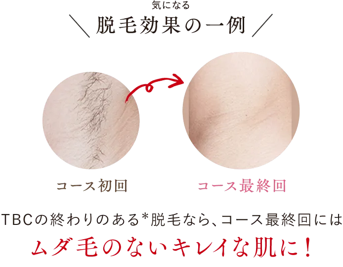 仙台でおすすめの脱毛サロン　エステティックTBC気になる脱毛効果の一例
