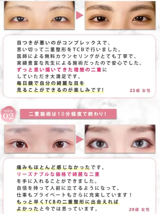 TCBの二重整形を受けた方の声