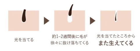 TBC 一般的な脱毛