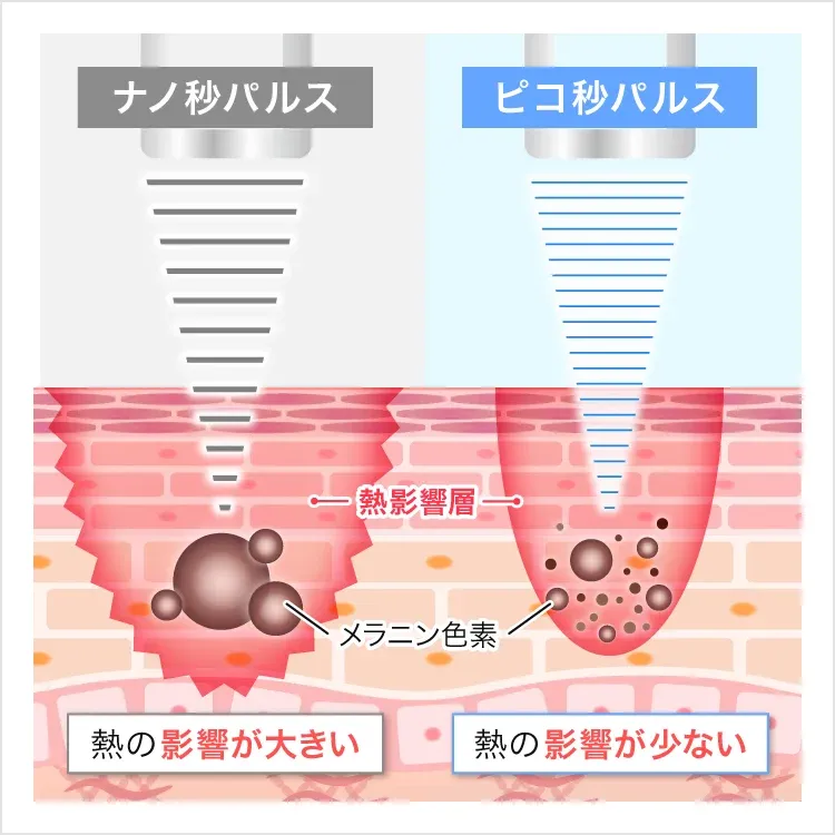 ピコレーザーの画像
