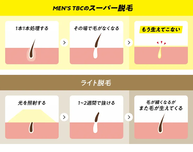 メンズTBCのヒゲ脱毛は美容電気脱毛