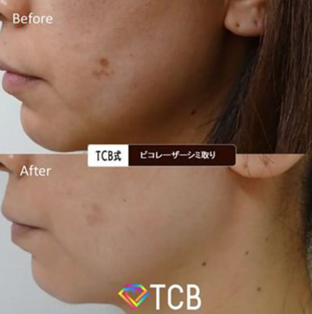 札幌でピコレーザーがおすすめのクリニック　TCBの症例写真