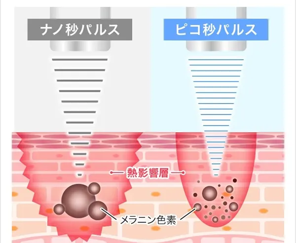 横浜で安いピコレーザーがおすすめのクリニック　施術方法