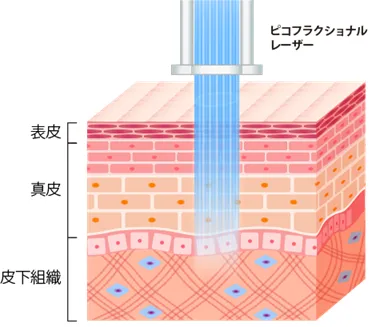 ピコフラクショナルの仕組み