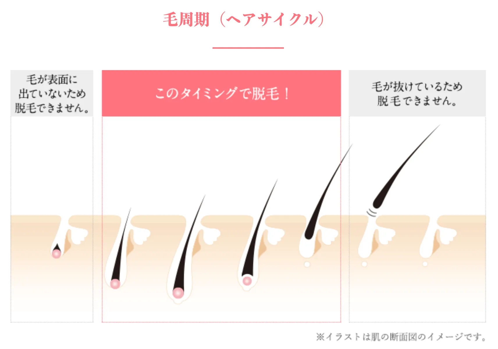 エステティックTBCスーパー脱毛の施術内容