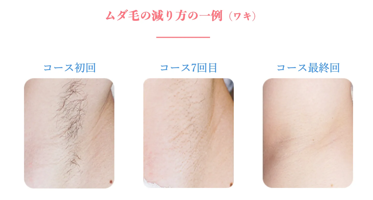 エステティックTBCスーパー脱毛の症例写真