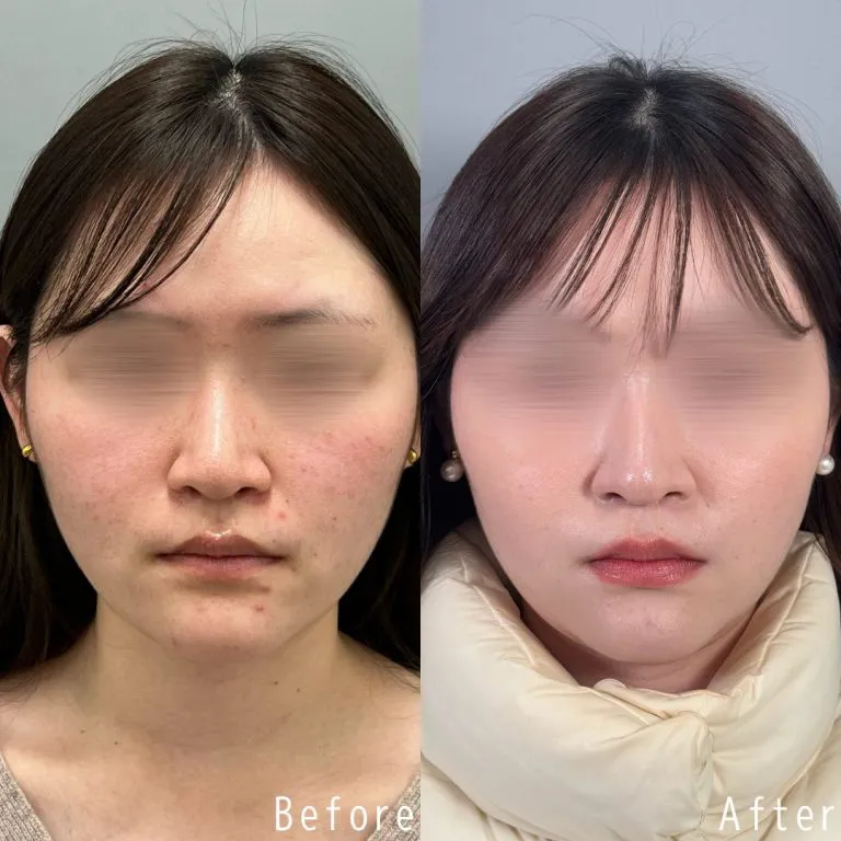 TCBのニキビ跡治療の症例