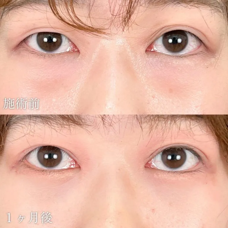 TCBのクマ取りの症例