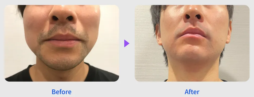 レジーナクリニックオムのヒゲ脱毛症例写真
