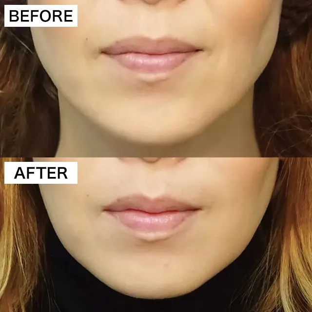 TCBのボトックスの症例