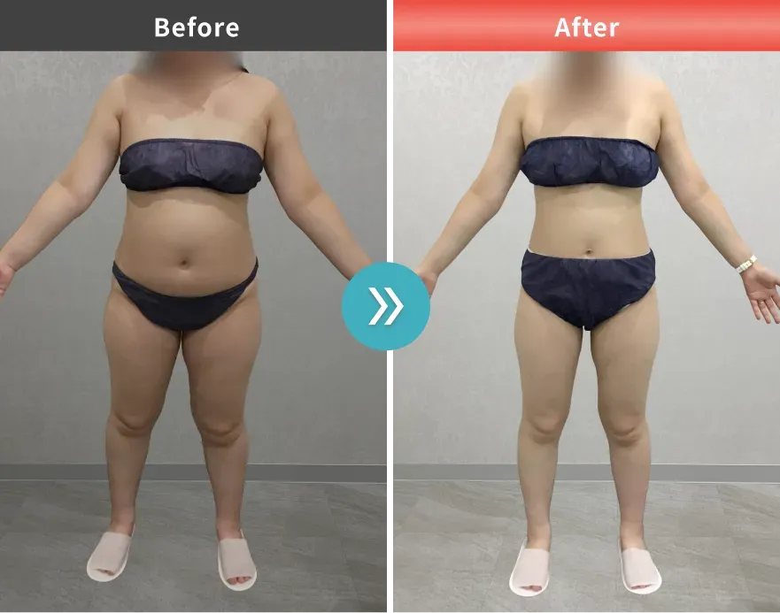 URARAクリニックの医療ダイエットの症例