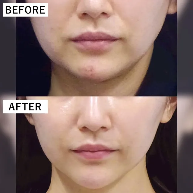 TCBのボトックスの症例