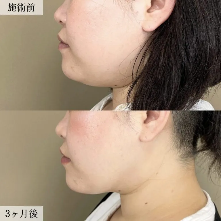 TCBの顔の脂肪吸引の症例