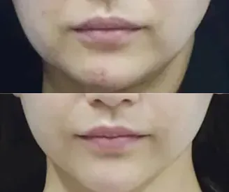 TCBの脂肪溶解注射の症例