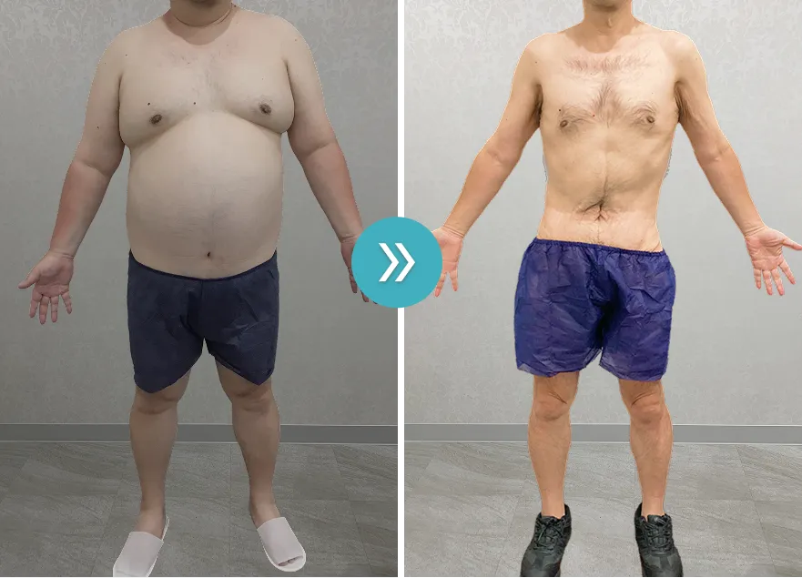 URARAクリニック医療ダイエットモニターの症例