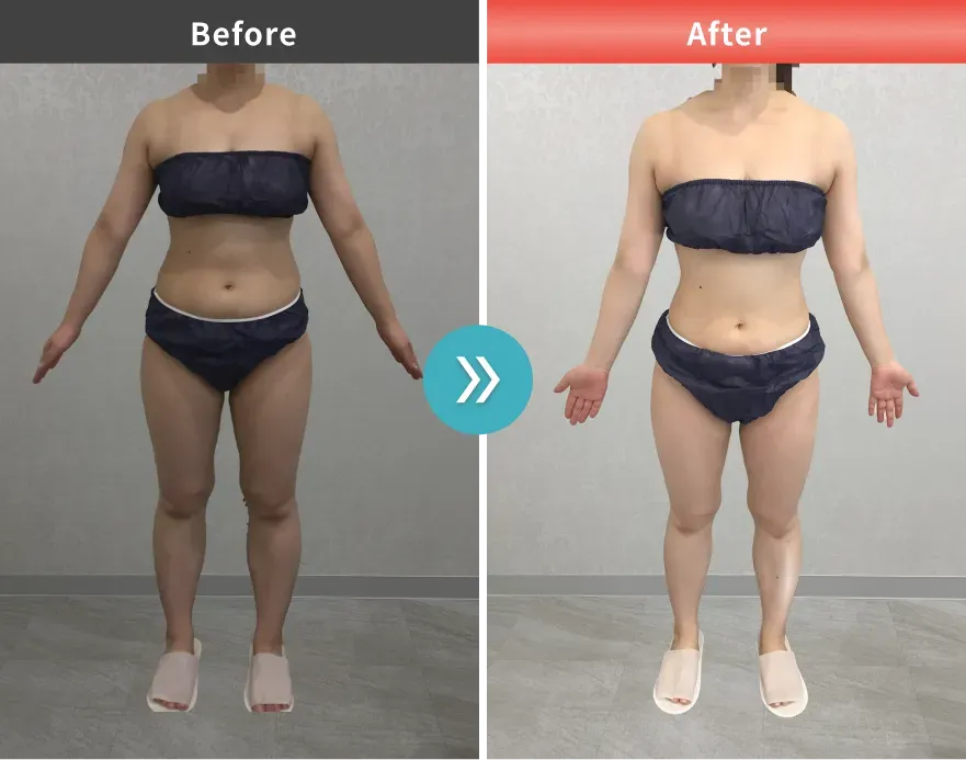 URARAクリニックの医療ダイエットの症例