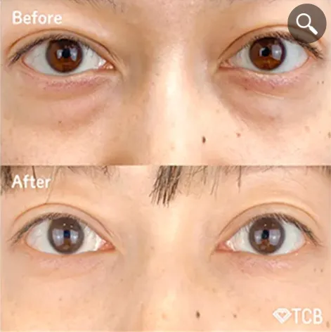 TCBのクマ取り症例①