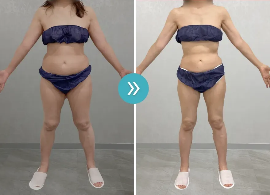 URARAクリニック医療ダイエットモニターの症例