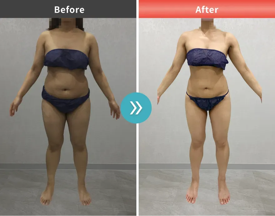URARAクリニックの医療ダイエットの症例